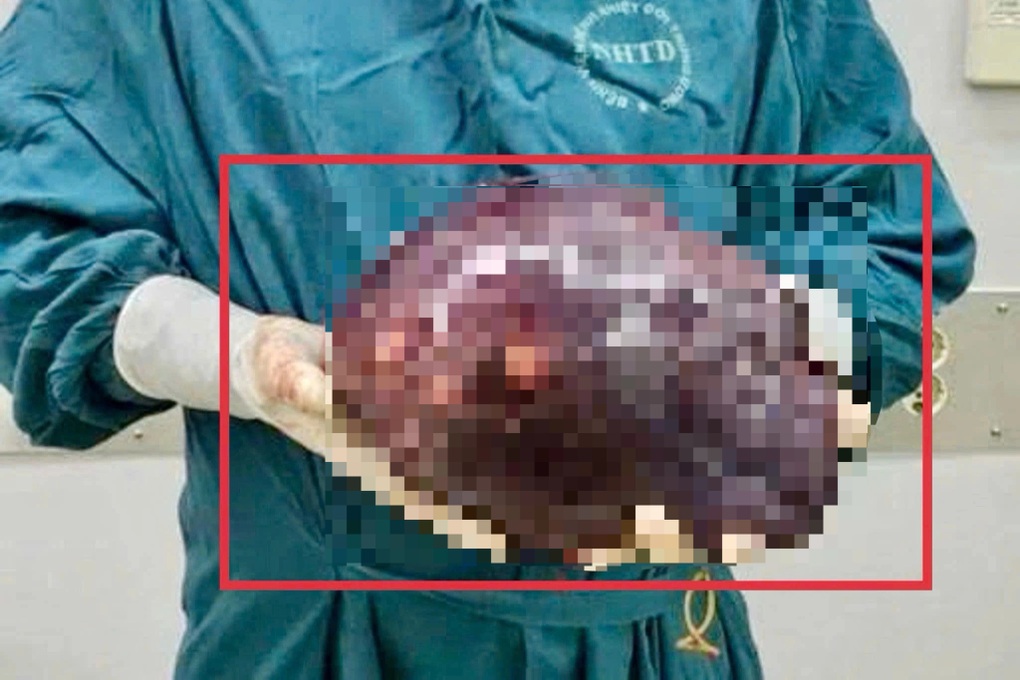 Khối u gan to như quả bóng vì chủ quan với bệnh phổ biến - 2