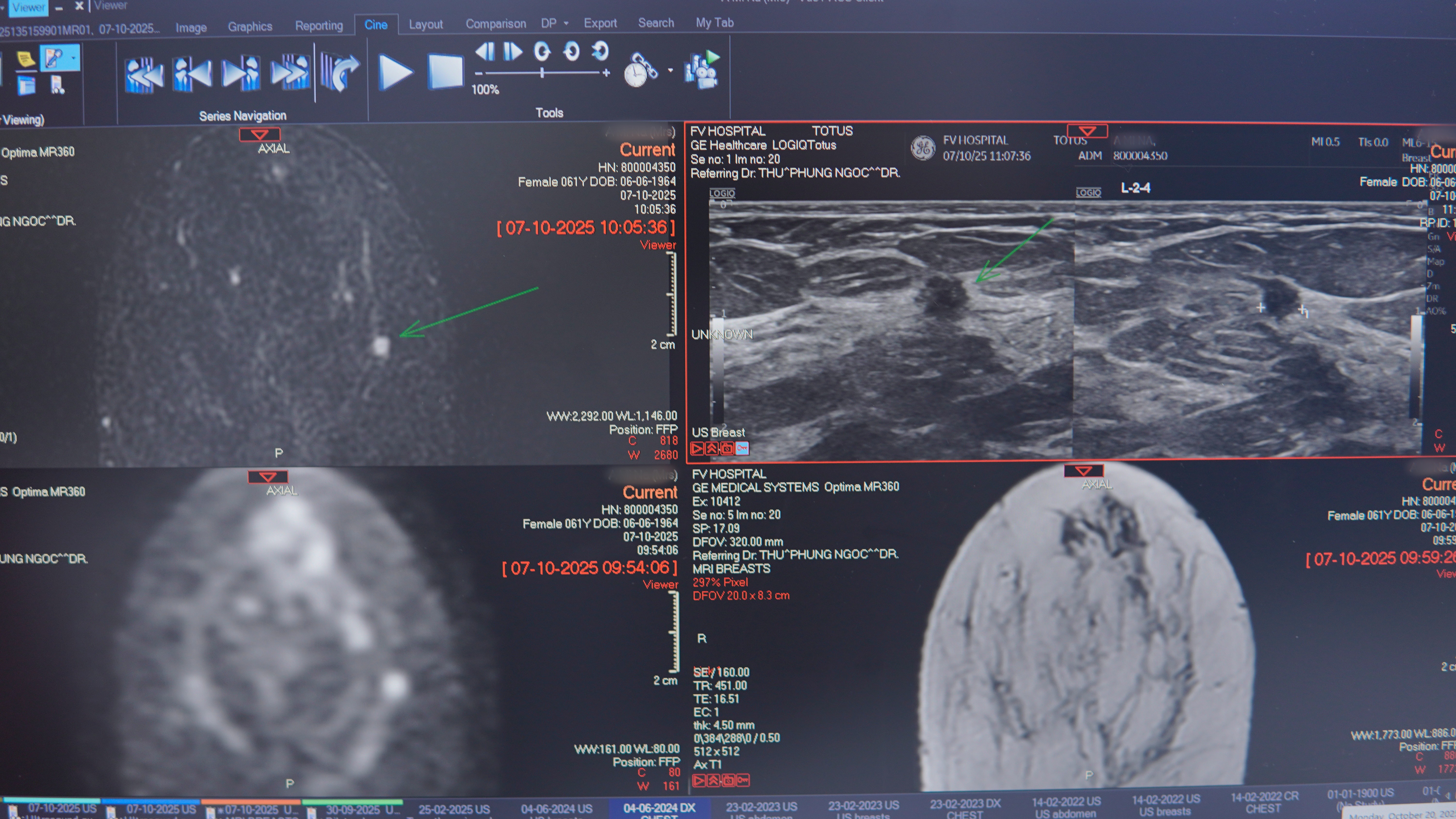 Bệnh nhân 61 tuổi chiến thắng ung thư vú nhờ phát hiện sớm 2 Hình chụp MRI cho thấy một tổn thương 3mm. Ảnh: FV