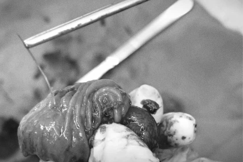 Ăn bát bún cá dính xương, người đàn ông thủng ruột non - 1