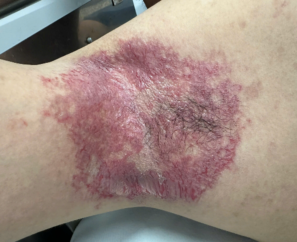 Bác sĩ Việt Nam điều trị thành công bệnh da di truyền hiếm nhờ tiêm botox - 1