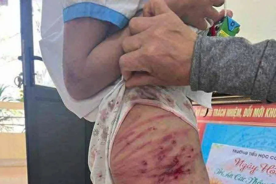 Em L bị cha dượng đánh gây ra nhiều vết thương trên người. bị cha dượng đánh.jpg