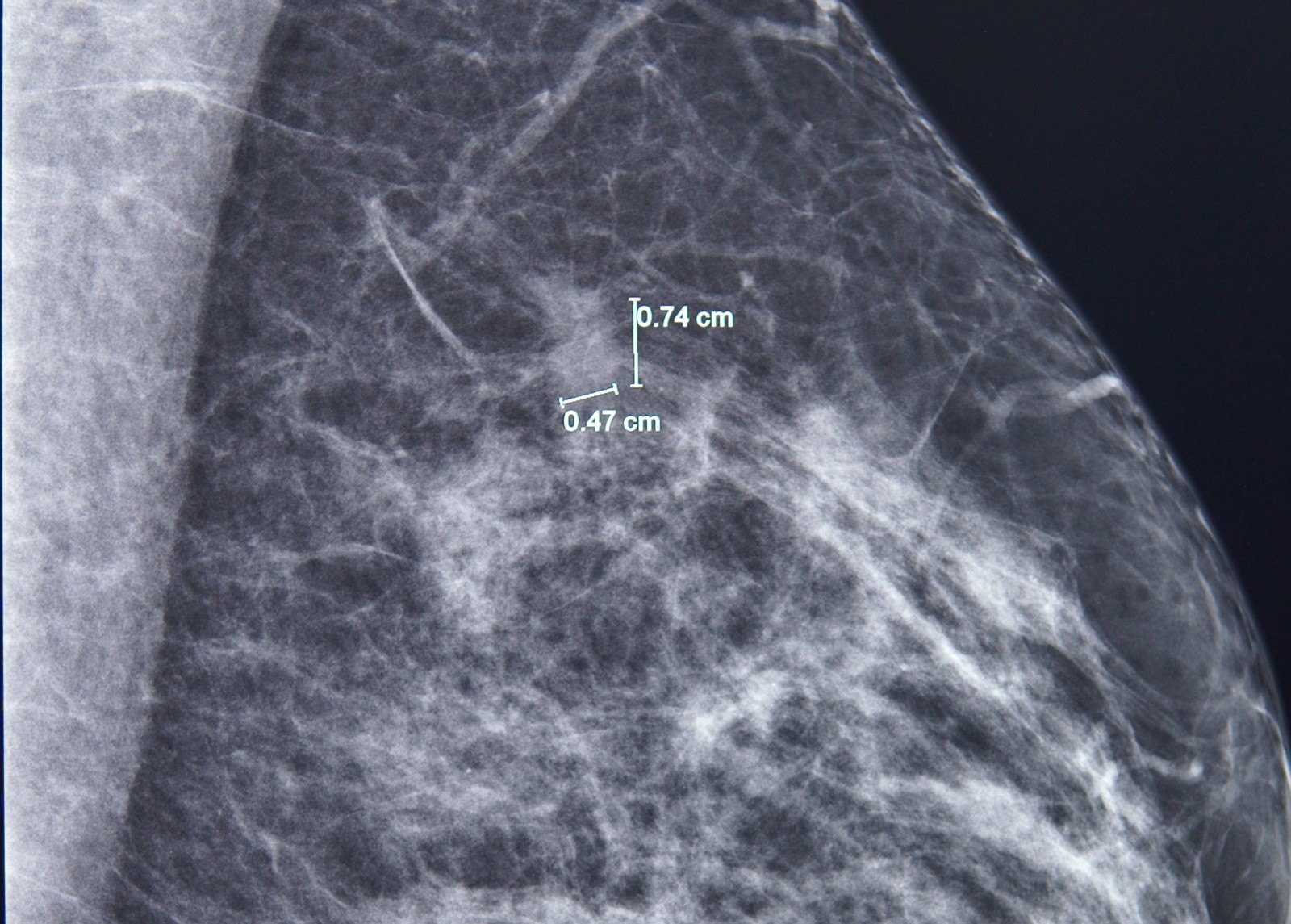 Bệnh nhân 61 tuổi chiến thắng ung thư vú nhờ phát hiện sớm 1 Phát hiện một tổn thương 7mm ở vú trái bằng chụp nhũ ảnh. Ảnh: FV