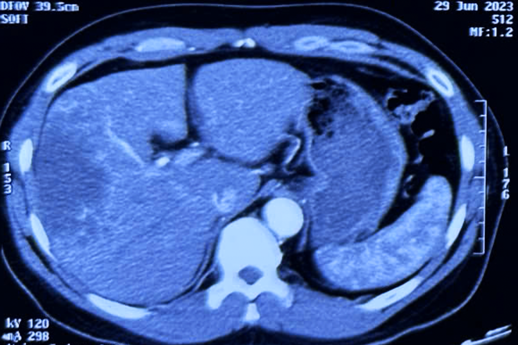 Căn bệnh ung thư 80% ca mắc phát hiện đã trễ, tử thần từ món gỏi cá sống - 1
