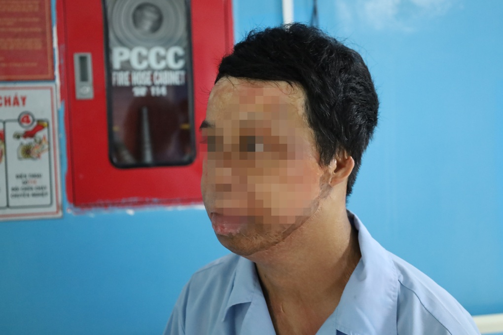 Chàng trai hóa “ngọn đuốc sống” vì hút thuốc khi đổ xăng, đi mổ hơn 20 lần - 1