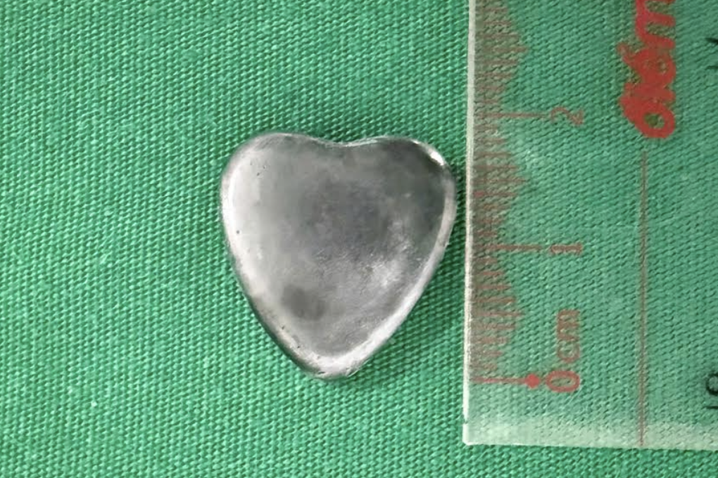 Chơi trước nhà, bé trai 5 tuổi bị chó béc-giê cắn biến dạng mặt nặng nề - 3