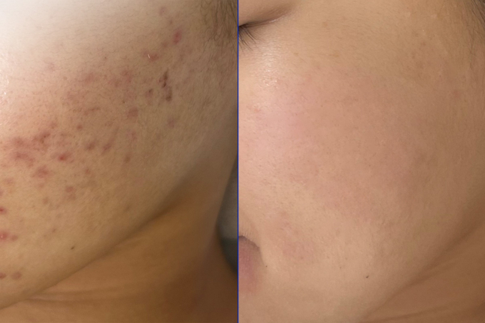 Sau hai tháng điều trị kết hợp đa tầng, các sẹo mụn trên mặt Trâm giảm đáng kể. Ảnh: Bệnh viện Đa khoa Tâm Anh