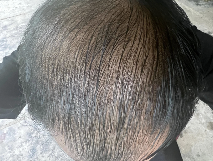 Một người đàn ông bị rụng tóc, vùng đỉnh đầu hói dần. Ảnh: Nhân vật cung cấp