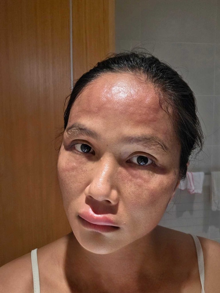 Gương mặt biến dạng sau sinh của H'Hen Niê