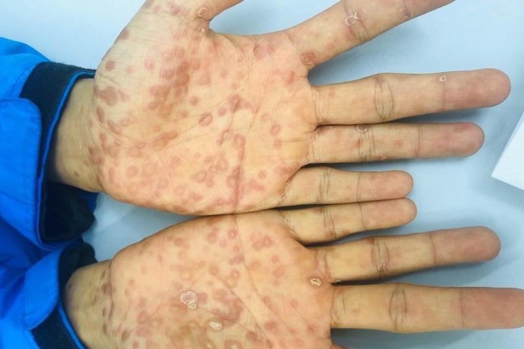 Hơn một nửa số ca mắc bệnh lây truyền qua đường tình dục xảy ra ở người trẻ - 1