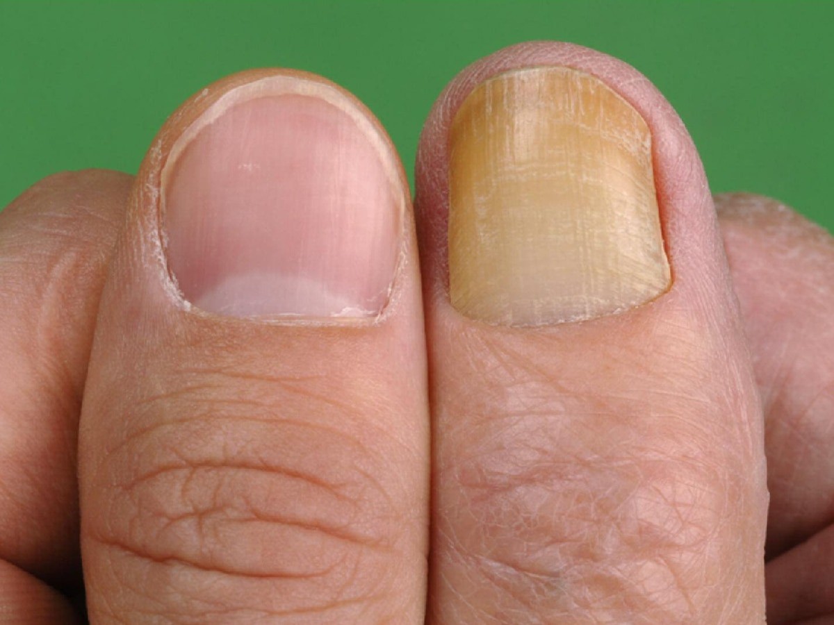 Móng tay chuyển sang màu vàng, coi chừng nguy cơ mắc bệnh nguy hiểm 1 Móng tay chuyển sang màu vàng, coi chừng nguy cơ mắc bệnh nguy hiểm - 1
