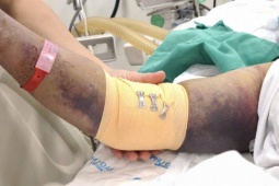 Nhiều người nguy kịch vì sốt xuất huyết