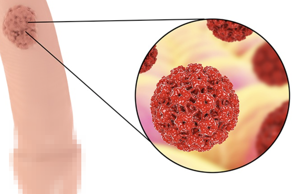 Người trẻ mắc ung thư vùng kín, vaccine có giúp điều trị bệnh? - 1