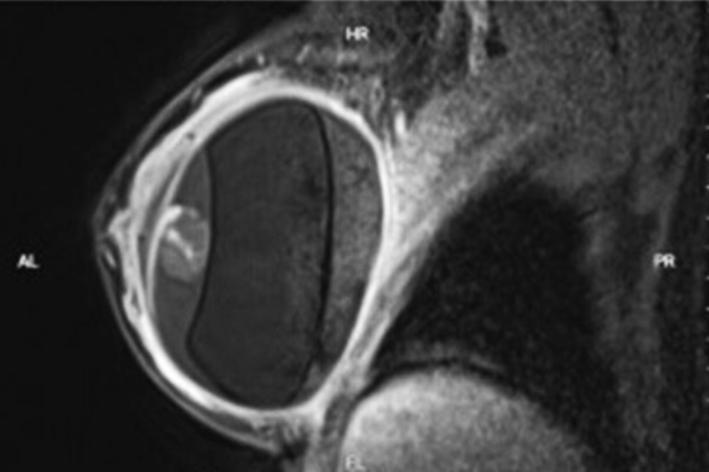 Nhiều phụ nữ gặp biến chứng nguy hiểm sau thời gian dài nâng ngực - 1