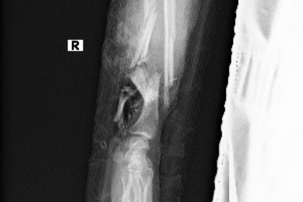 Vì sao bác sĩ phải ghép tạm tay đứt lìa vào chân cô gái mang song thai? - 1