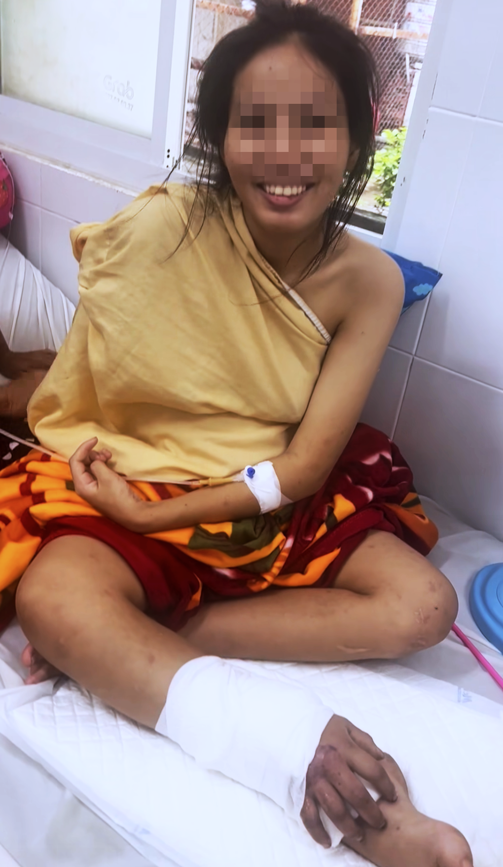 Vì sao bác sĩ phải ghép tạm tay đứt lìa vào chân cô gái mang song thai? - 4