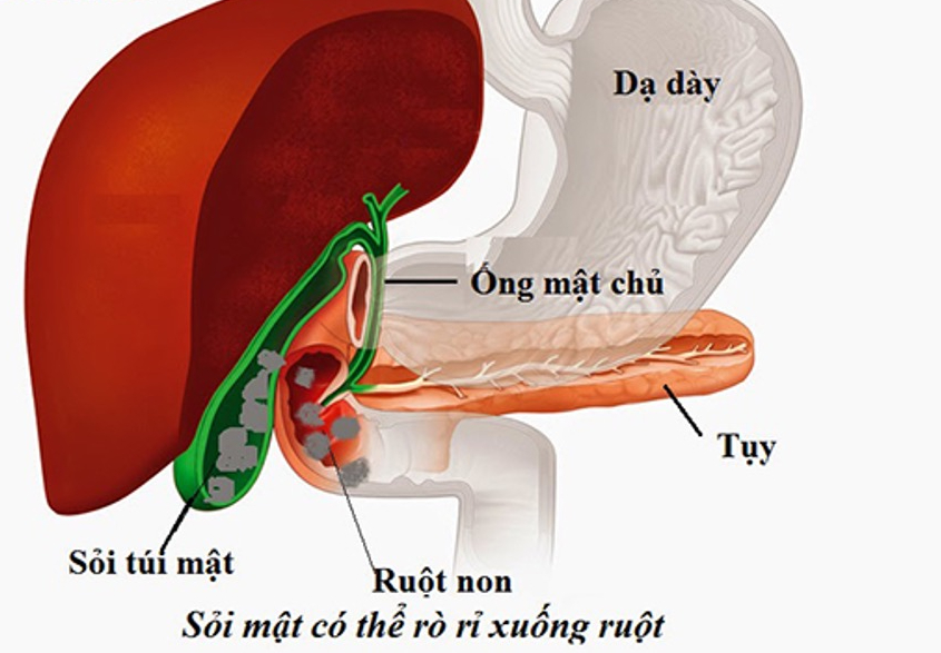 sỏi túi mật - Ảnh 1.