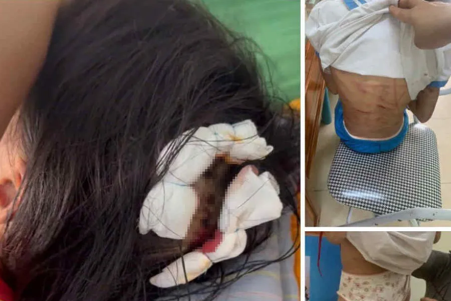 Hình ảnh những vết thương của em L bị cha dượng bạo hành tội giết người