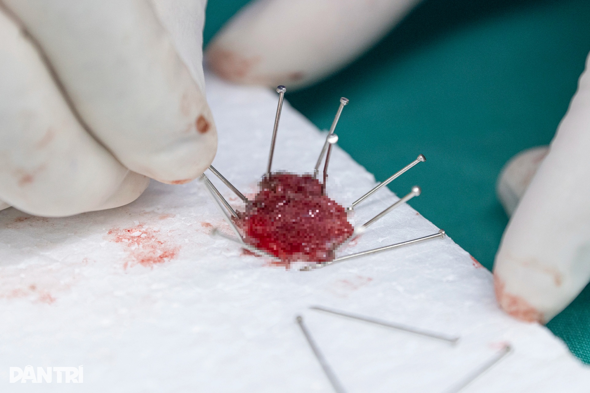 Xem bác sĩ thâm nhập dạ dày truy vết ung thư - 1