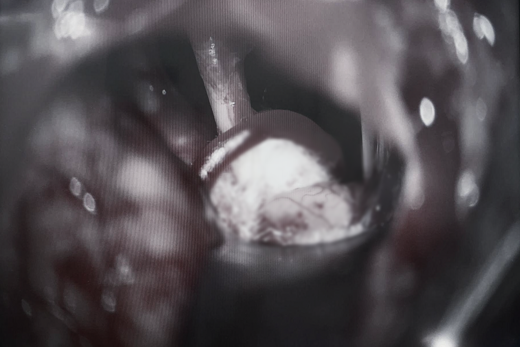 Người phụ nữ mắc căn bệnh nguy hiểm suốt 1 năm nhưng lại tưởng “điềm lành” - 2