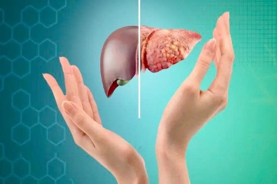 Thấy nước tiểu có 5 dấu hiệu này coi chừng gan đang "kêu cứu" - 7