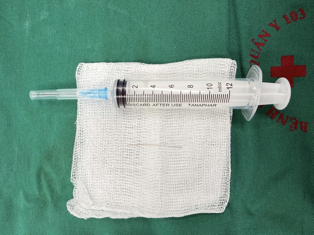 Dị vật 6cm “mắc kẹt” trong thắt lưng vì tự châm cứu - 2