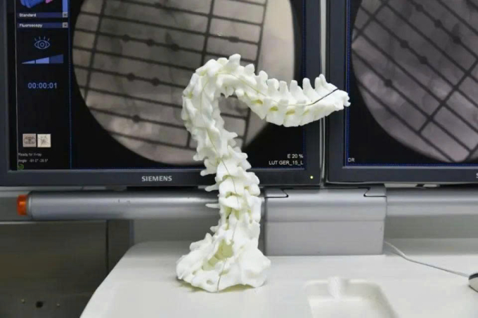 Mô hình in 3D về cột sống của Luo. Ảnh: QQ