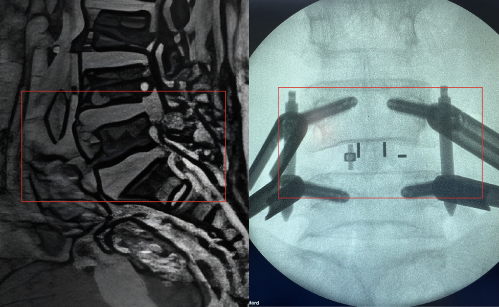 Thử thách cứu người phụ nữ đối diện nguy cơ không thể đi lại - 3