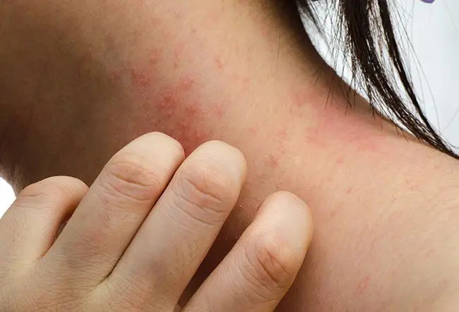 Những loại ung thư nguy hiểm có chung đặc điểm gây ngứa da - 2