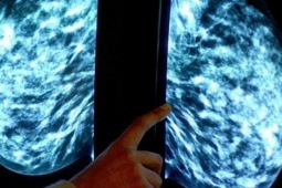 Đột phá trong chữa ung thư vú nhờ bảo quản mô trong gel