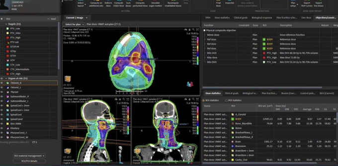 AI mô phỏng lập kế hoạch xạ trị cho một ca ung thư. Ảnh: Bác sĩ cung cấp