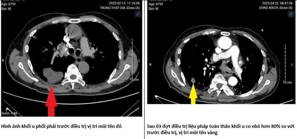 Người Việt dùng thuốc chữa ung thư “tương tự của Nga” kết quả thế nào? - 4