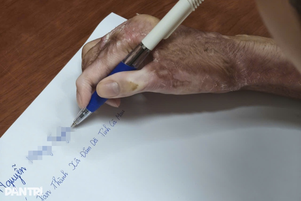 Thiếu nữ 17 tuổi bị bạn đốt keo nến làm cháy khắp người, phải mổ 15 lần - 3