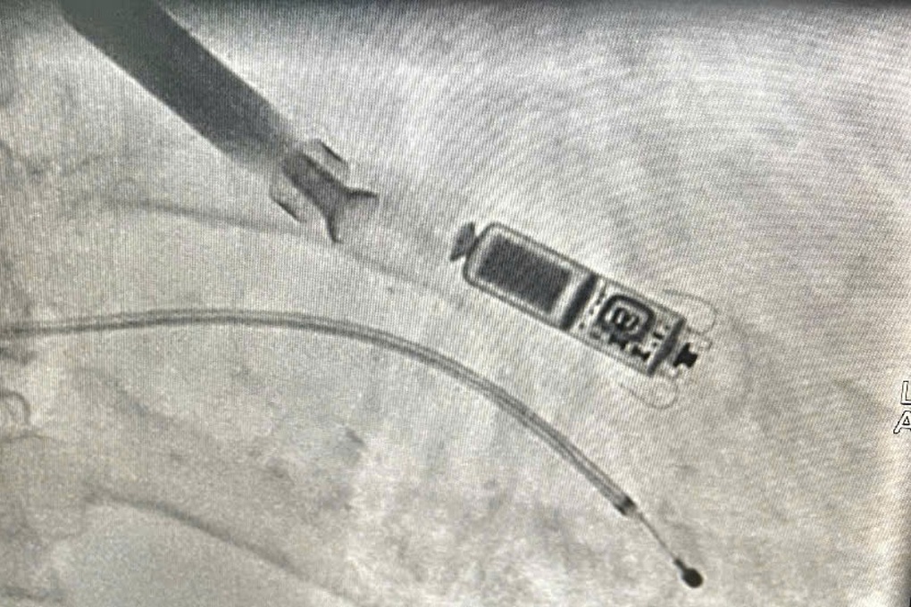 Thiết bị nhỏ bằng viên thuốc con nhộng giúp cụ bà 83 tuổi thoát đột tử - 3