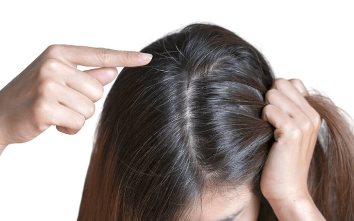 Thói quen thích nhổ tóc, có thể là bệnh lý tâm thần? - Ảnh 3.