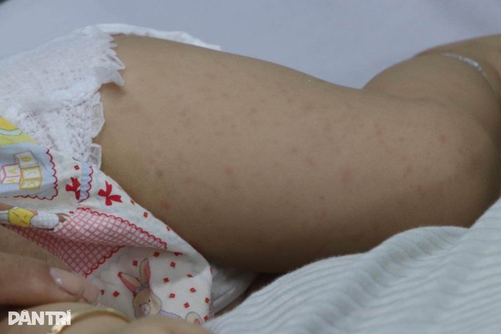 TPHCM tăng số ca mắc tay chân miệng, 2 dấu hiệu bệnh chuyển nặng cần chú ý - 2