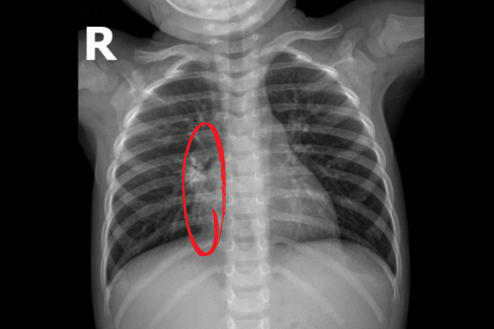 Bé gái 2 tuổi viêm phổi hoại tử sau 6 ngày ho, sốt - 2