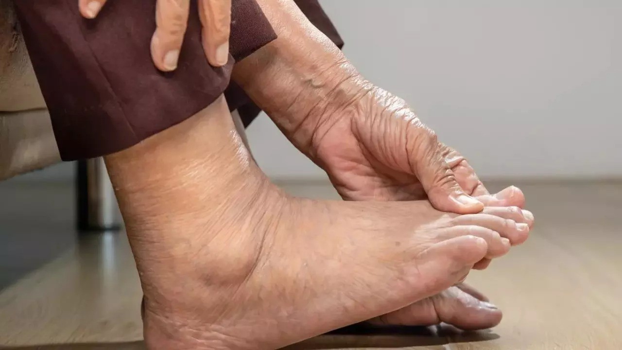 Dấu hiệu ở chân cảnh báo bệnh gan, suy tim và cục máu đông 5 Dấu hiệu ở chân cảnh báo bệnh gan, suy tim và cục máu đông - 4