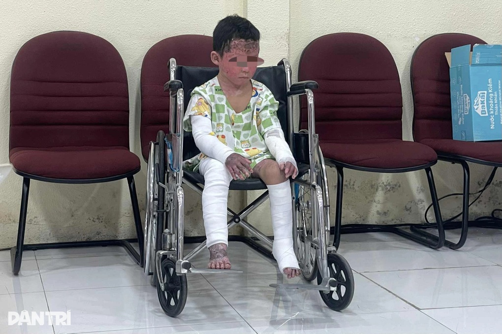 Bé trai phỏng 65% cơ thể, mồ côi cả cha lẫn mẹ sau cơn hỏa hoạn định mệnh - 2