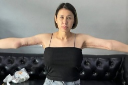Cánh tay biến dạng sau khi cắt bỏ da thừa hậu giảm cân