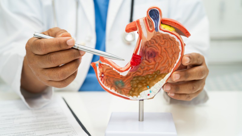 5 triệu chứng cảnh báo ung thư dạ dày dễ bị bỏ qua - 1