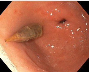 Hình ảnh nội soi dạ dày thấy dị vật hạt táo đỏ 1 đầu nhọn đâm vào thành hang vị dạ dày. BVCC