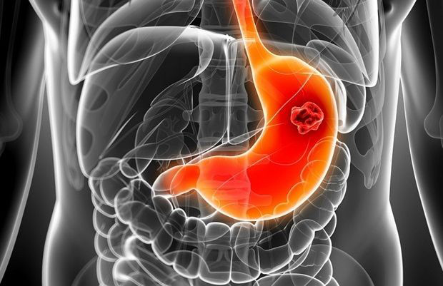 ung thư dạ dày - Ảnh 1.