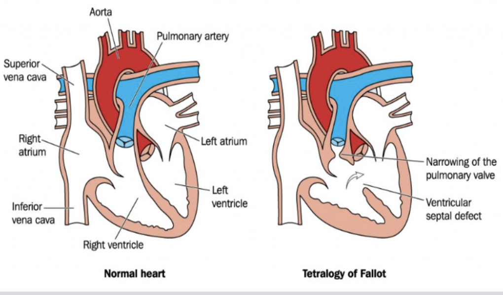 Căn bệnh hiểm ở tim, trẻ mắc phải dễ tử vong trước tuổi trưởng thành - 1