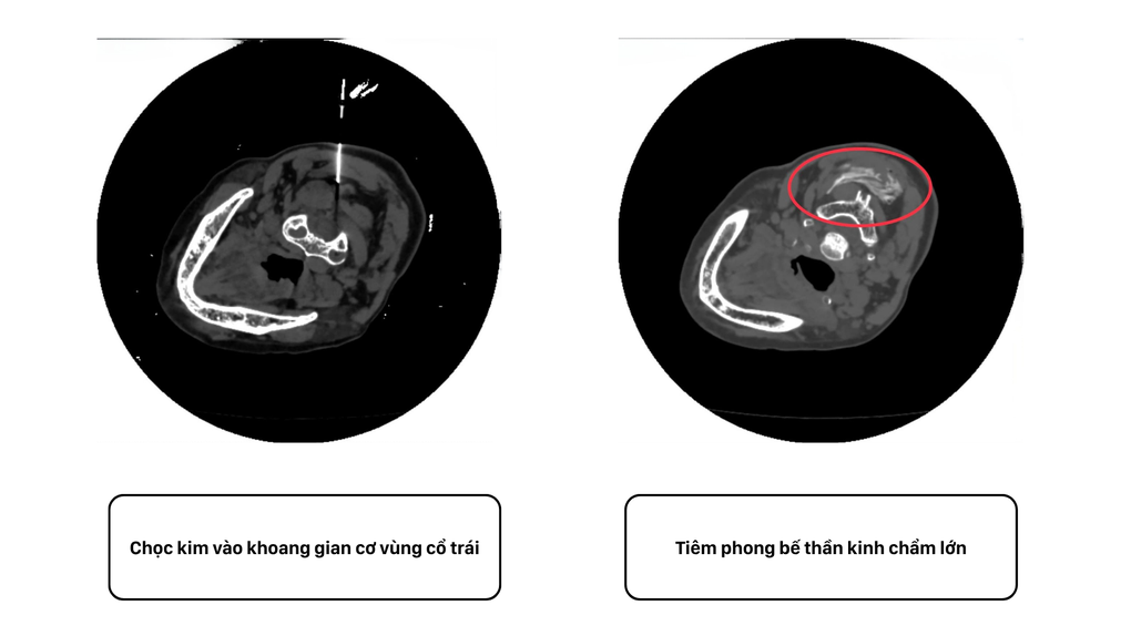 Cắt cơn đau đầu dữ dội trong 3 năm bằng tiêm phong bế thần kinh chẩm - 2