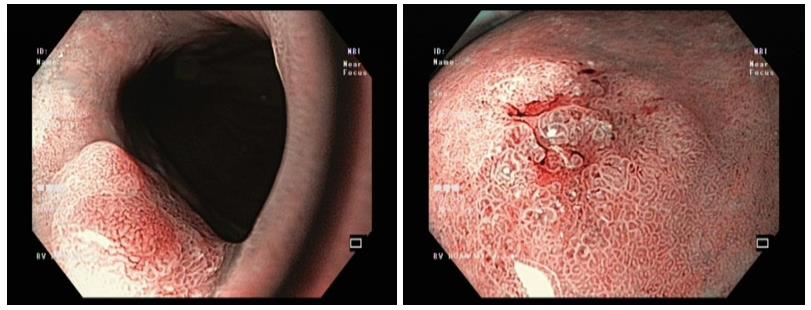 Cắt tách qua nội soi (ESD) - giải pháp an toàn, không cần phẫu thuật - Ảnh 1.