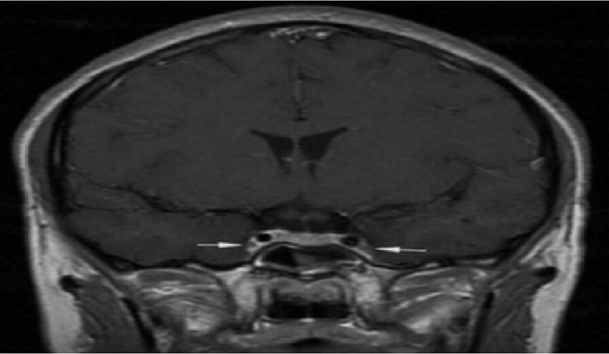 Vị trí mũi tên là viêm và co thắt động mạch cảnh trong 2 bên. Ảnh: Bệnh viện cung cấp