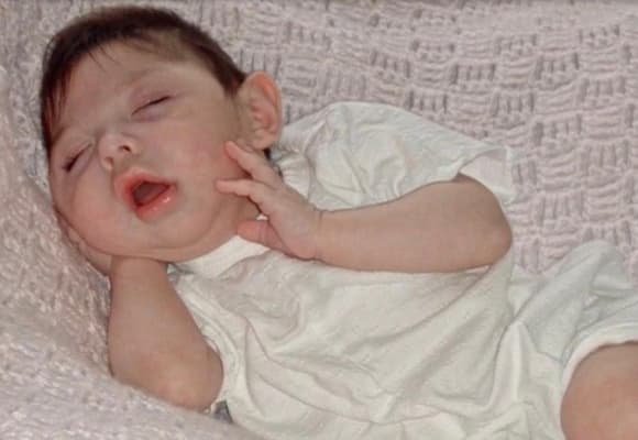 Alex Simpson, hội chứng hydranencephaly, Cô bé sinh ra không có não