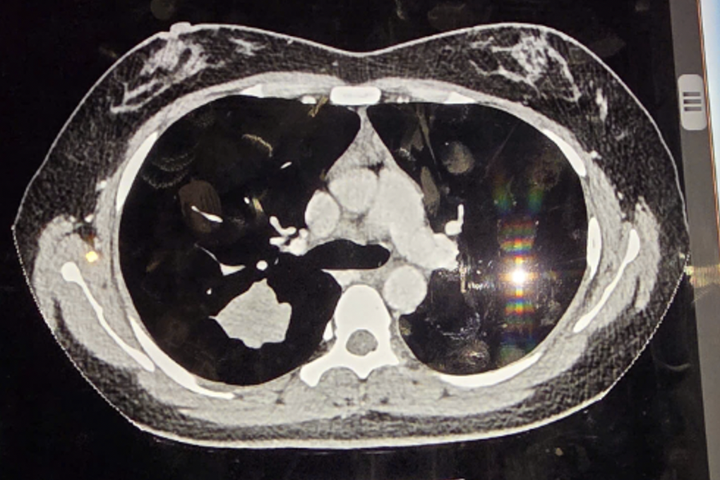 Cô gái 29 tuổi, không hút thuốc, bàng hoàng phát hiện mắc ung thư phổi - 1