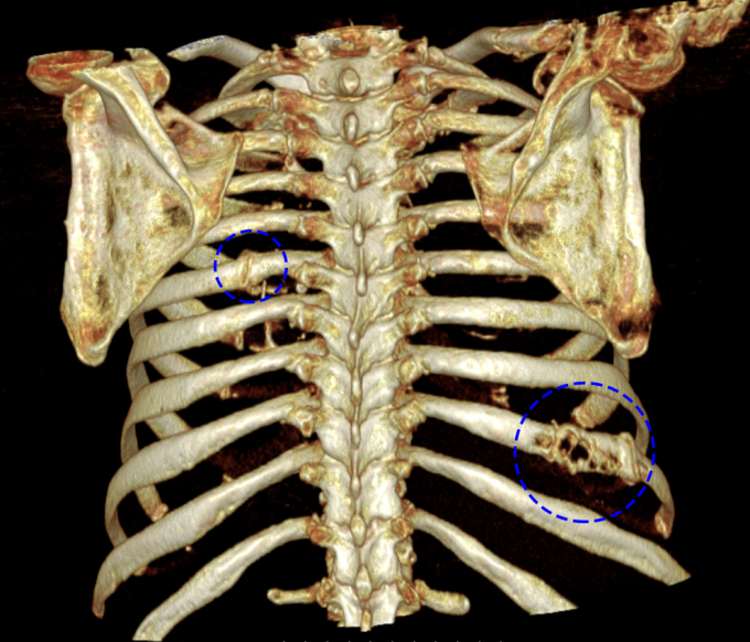 Tổn thương tiêu xương của ông Thịnh trên phim chụp CT. Ảnh: Bệnh viện Đa khoa Tâm Anh