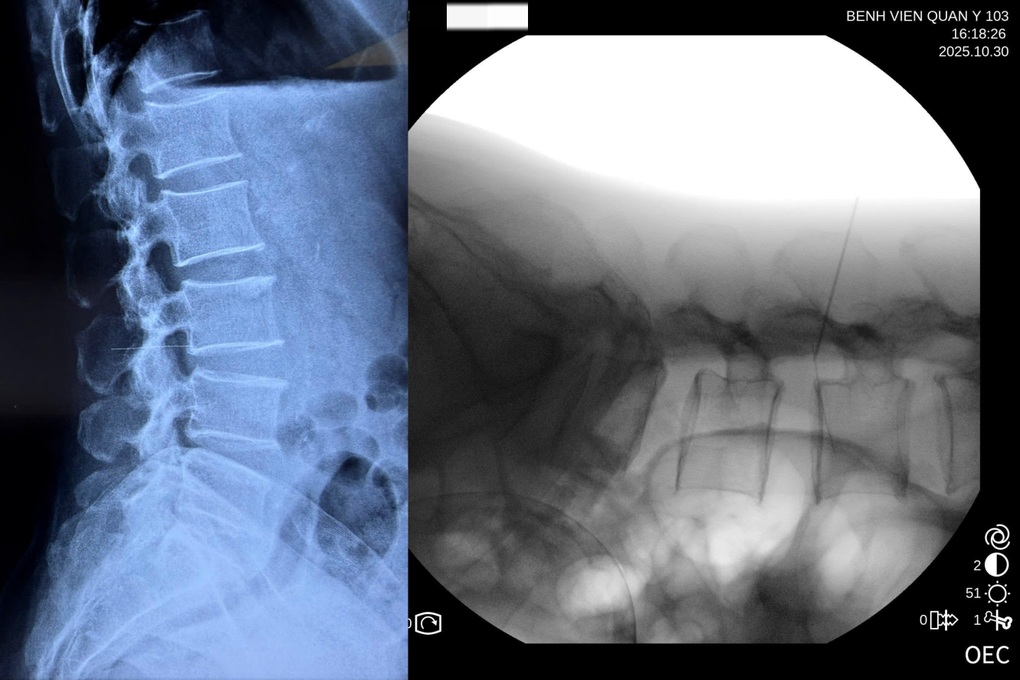 Dị vật 6cm “mắc kẹt” trong thắt lưng vì tự châm cứu - 1